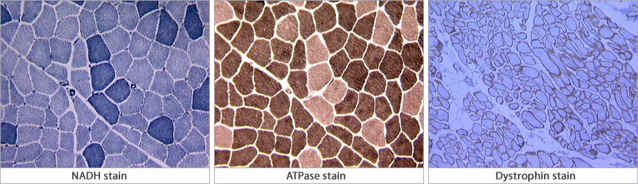 Muscle Biopsy Images: NADH stain (first pic) ATPase stain (middle pic) and Dystrophin stain (third pic).