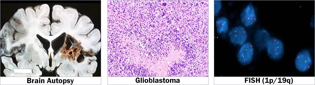 Brain Autopsy, Brain Tumor, FISH