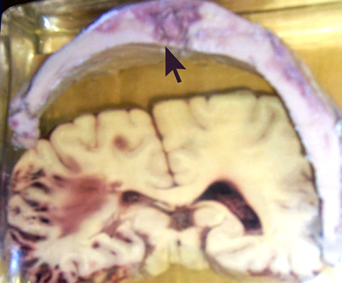 case113